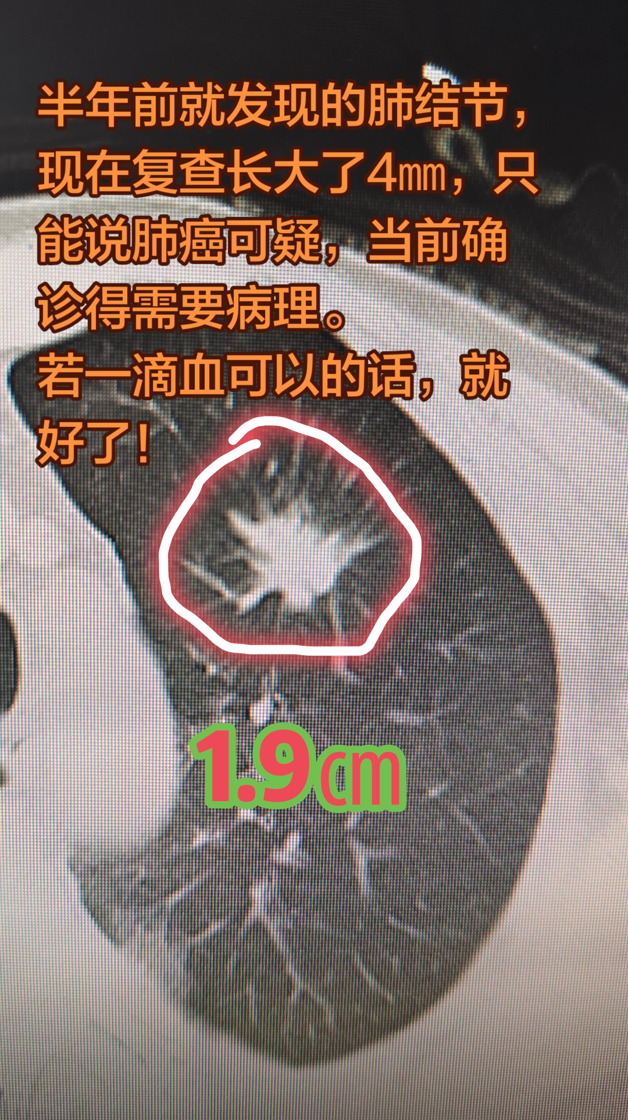 肺结节的良恶性确诊是什么？半年前就发现的肺结节，现在复查长大了4㎜，只...