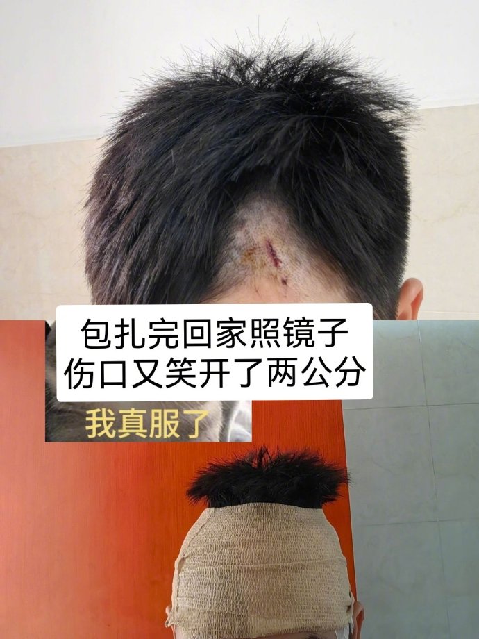 不建议在包扎后照镜子