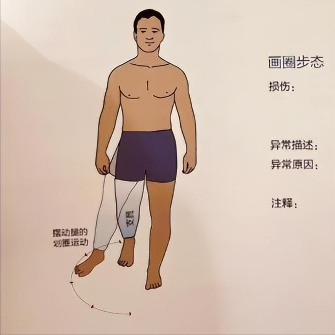 偏瘫后走路总画圈？不是“没恢复好”，背后原因要分清！偏瘫后走路总画圈，是不是