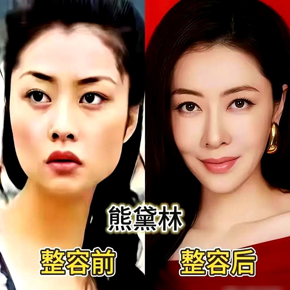 “我脸上的填充物全抽了，多余的全溶了。”沈梦辰在镜头前指着自己的脸，连何炅都愣了一下。综艺里被人贴上