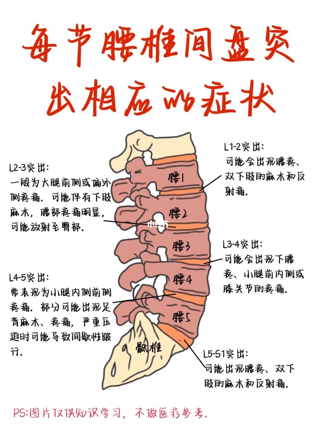 医学生笔记——腰椎间盘突出
