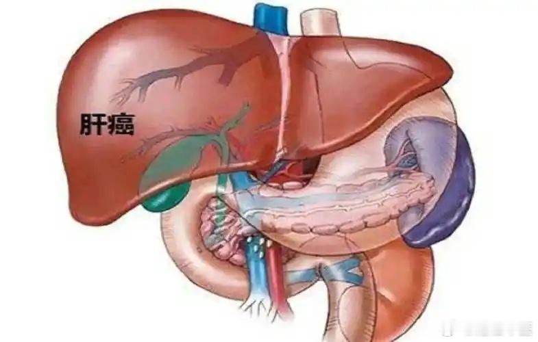 为什么，中国肝癌患者居高不下！常吃这3种食物的人易患肝癌：1，发霉食物；如玉米、