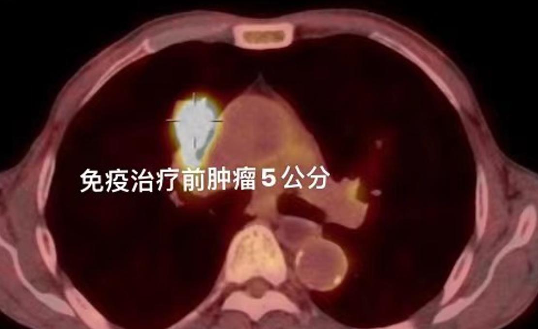 仅用3个月，76岁老人的肺部肿瘤，从原本的5cm缩小到1cm。这么好的治疗效果，