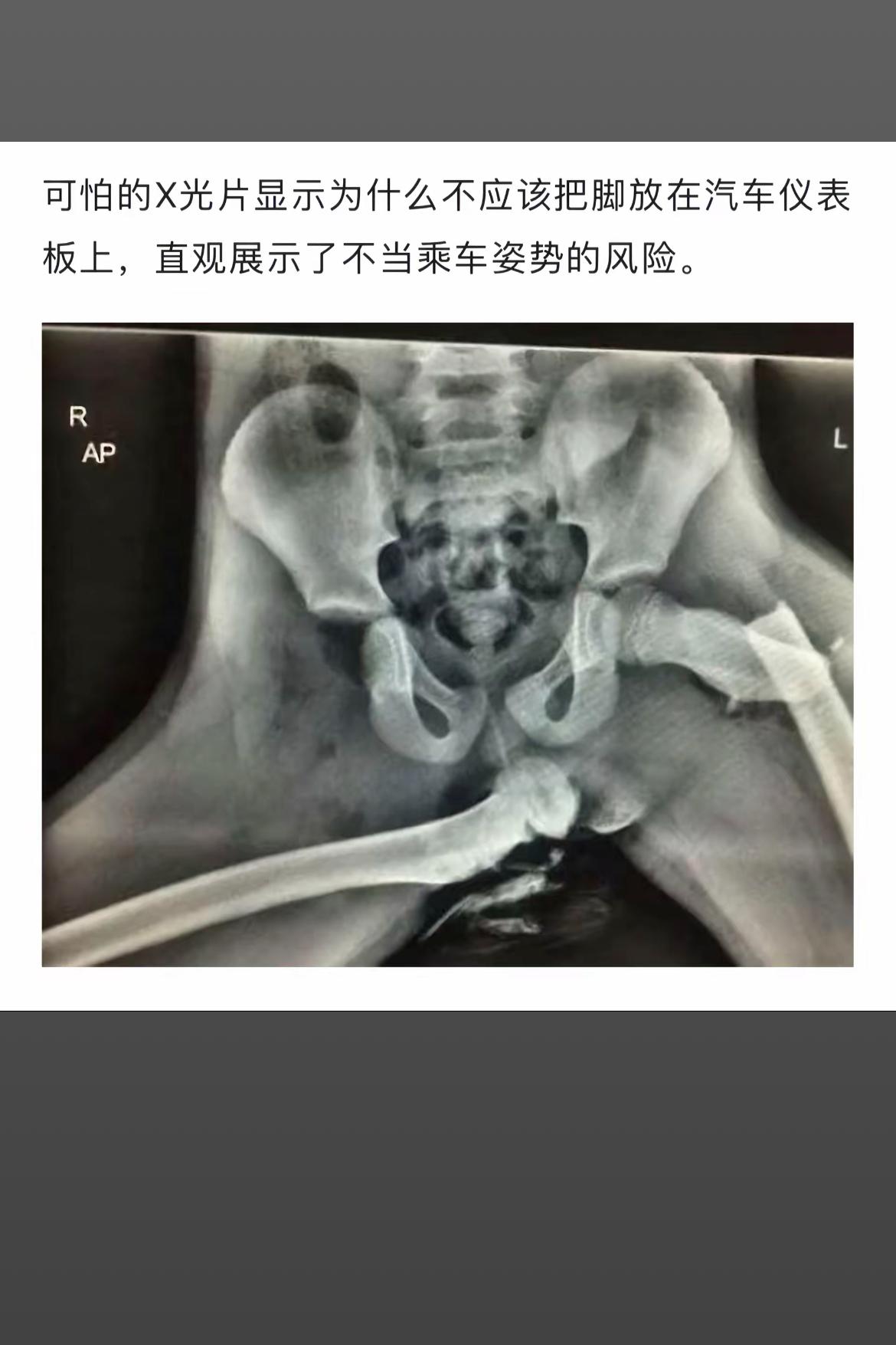 🚗当心！不正确的乘车姿势，X光片告诉你后果！🚫💢