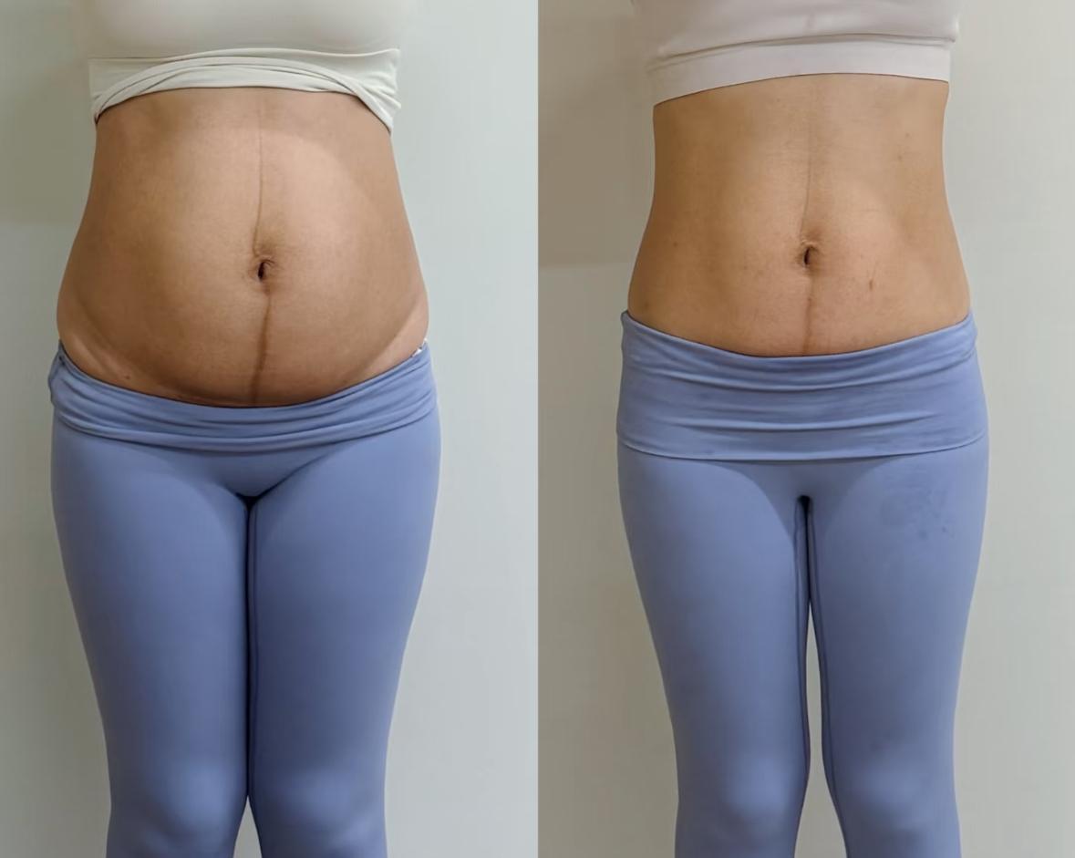 别信“产后三年就定型”的鬼话。你的子宫记得每一次胎动，你的腹肌认得那道裂缝——