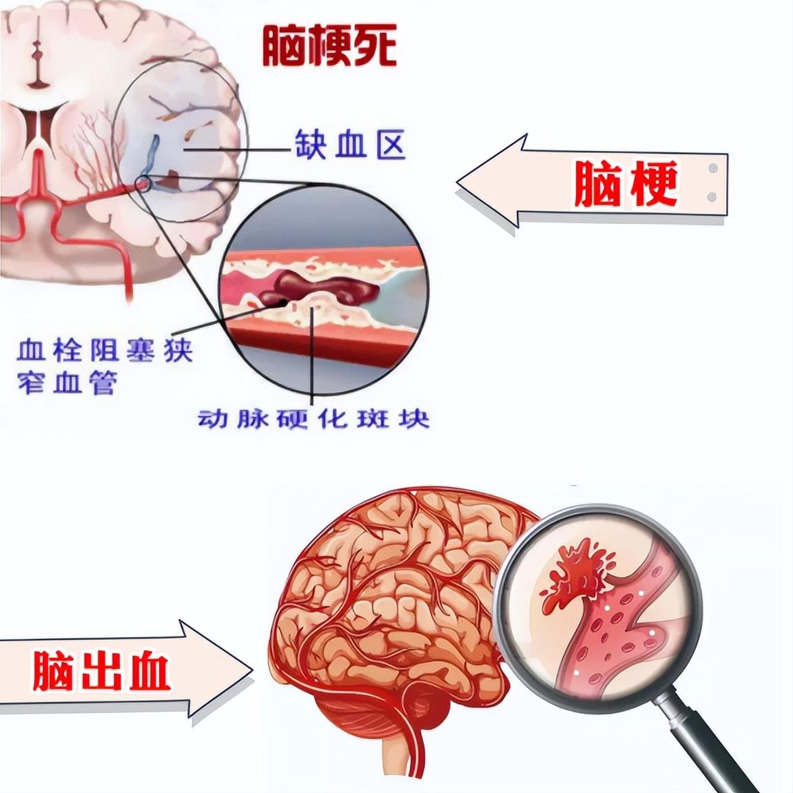 脑梗脑出血的朋友，恭喜你！出现这5种情况，说明你正在恢复！第一，麻木感或刺