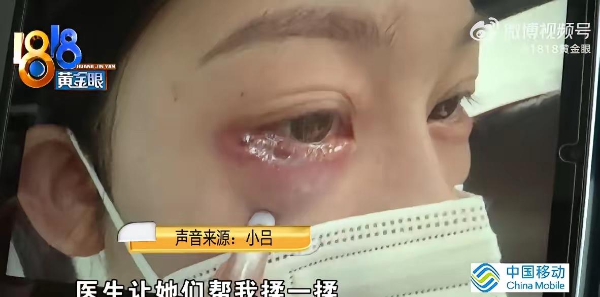 杭州姑娘小吕两年前心血来潮，想着给自己的眼睛添点神采，就去一家医院做了面部注射，