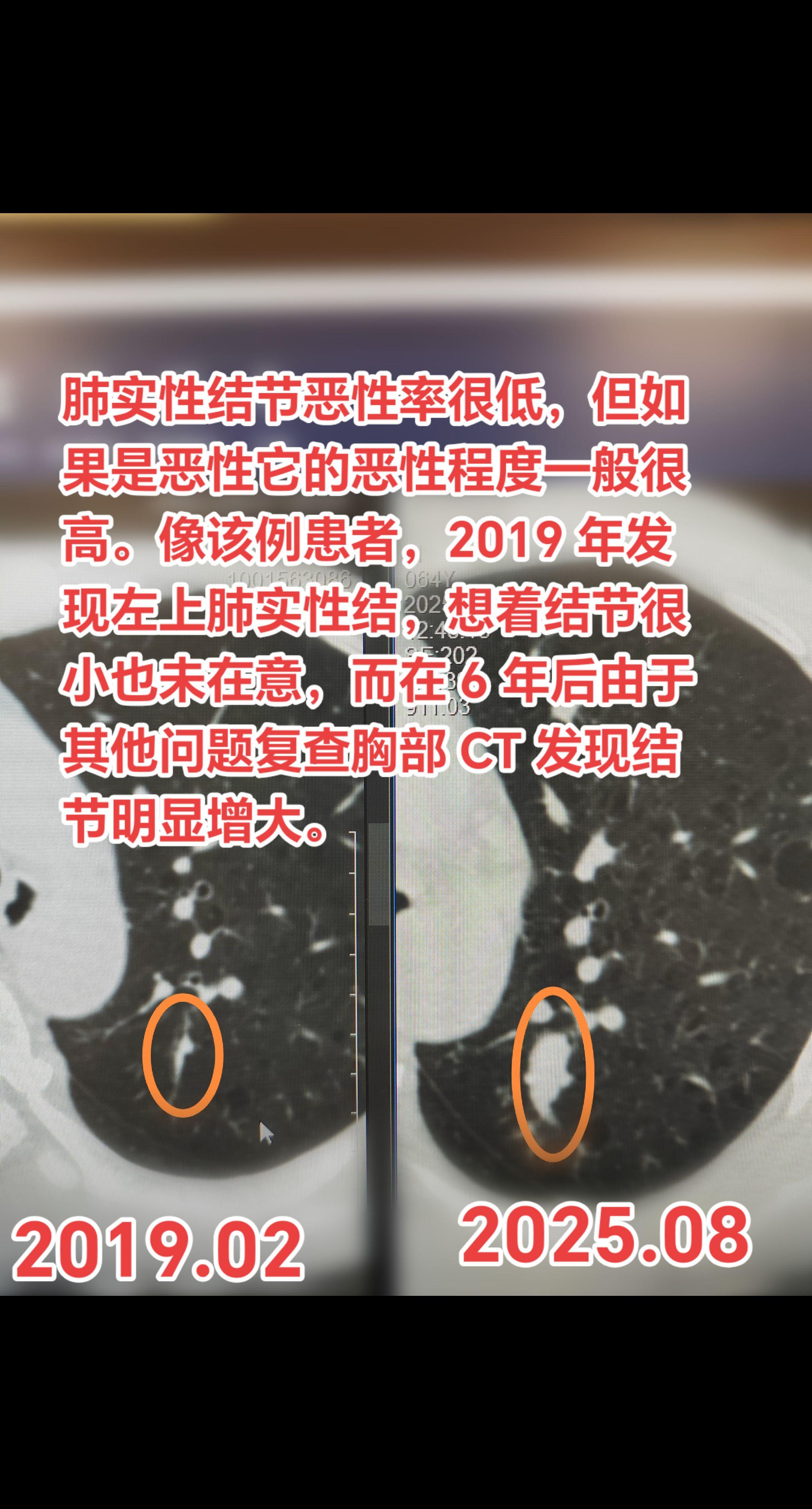 发现实性结节一定要定期复查！肺实性结节恶性率很低，但如果是恶性它的恶性...