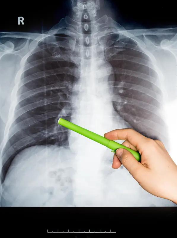 日前，有位患者就像个“老烟枪”，烟龄那叫一个长，而且每年都雷打不动地去做肺CT检