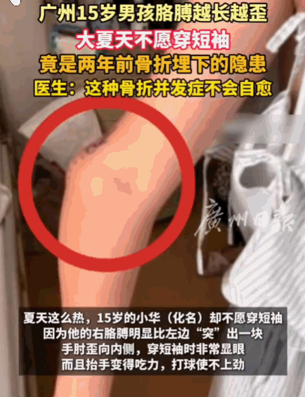 悲剧还是发生了！广东，一少年两年前不慎摔伤致右臂骨折，当时送医治疗后骨头顺利愈合