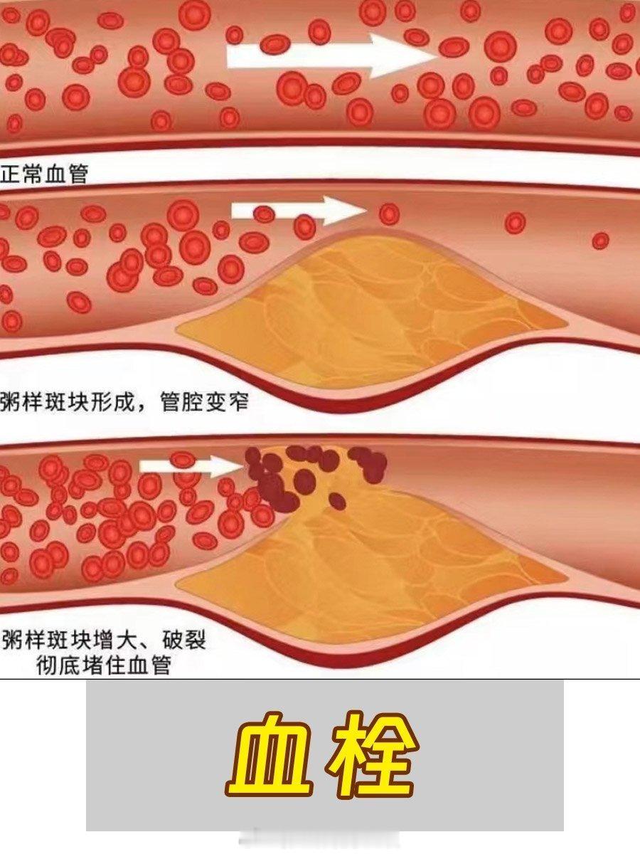 【贴士】血栓是导致脑梗、心梗的“隐形杀手”，严重威胁生命健康。预防血栓，需从饮