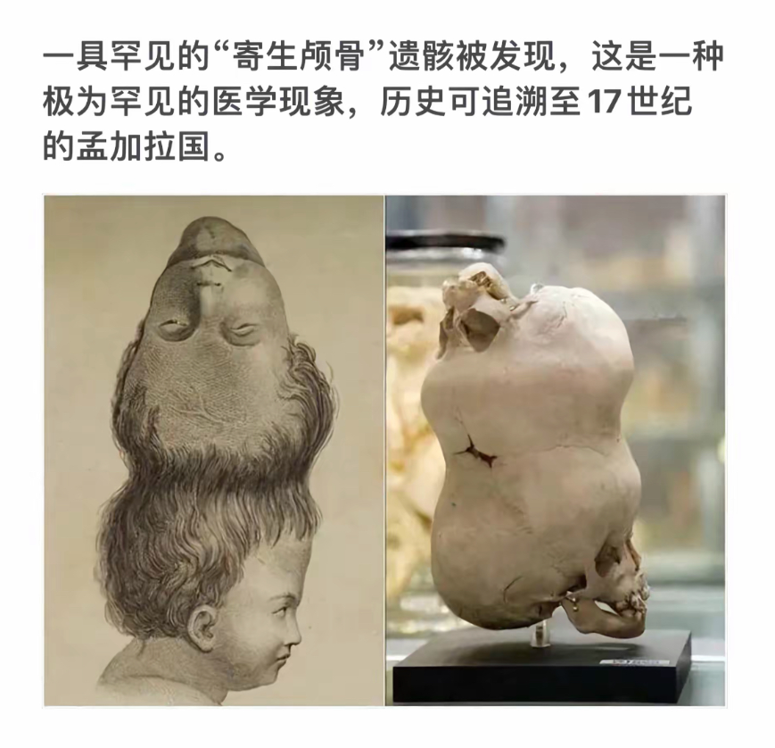 “寄生颅骨”的神秘发现，追溯至17世纪的孟加拉国！