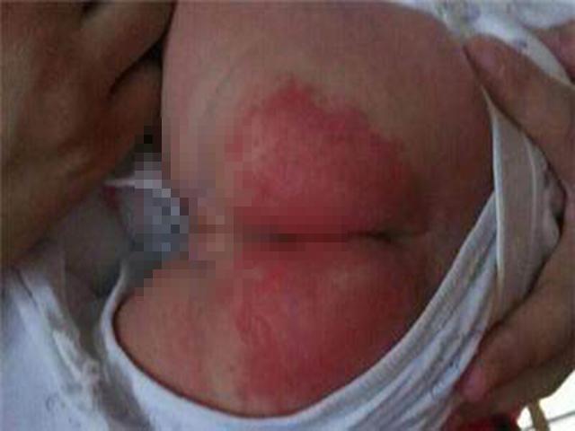 妈妈给孩子用这样的纸尿裤, 导致孩子严重过敏, 好多准妈妈还这样做