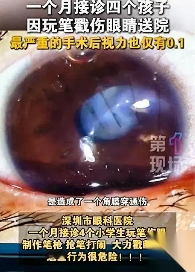 四个孩子眼睛被笔戳伤！十岁男孩视力永久损伤这种危险