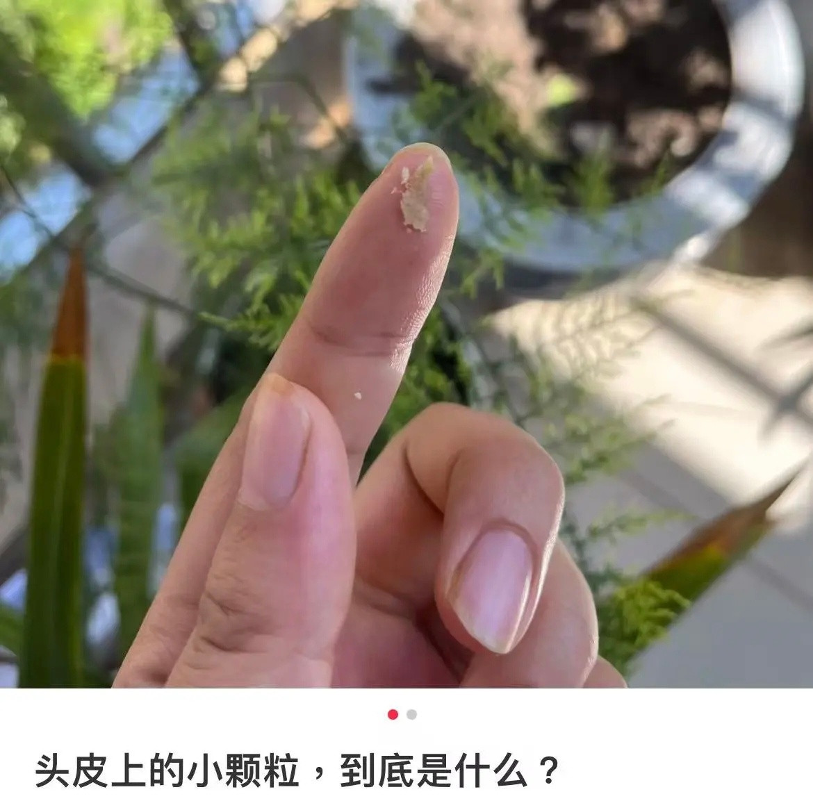 【头皮上抠出来的“白泥”到底是啥？】当你几天不洗头时，手指不经意间挠过头皮，指甲