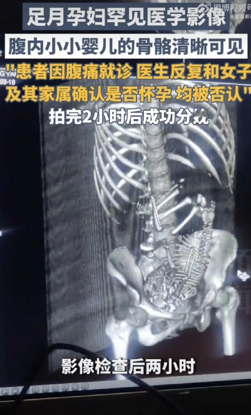 19岁女孩腹痛就医，2小时后突然生娃！自己都懵了：完全不知道怀孕…真是活久见