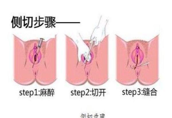 顺产时为什么还要“挨刀”? 教你如何去避免
