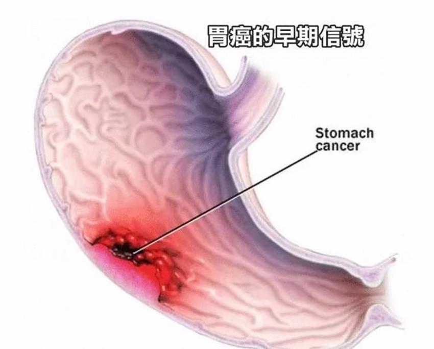幽门螺旋杆菌致癌风险有多高？这个指标可评估谈到胃癌，这是一个让人人都可怕的疾