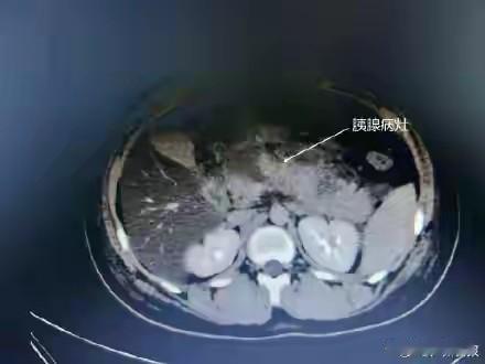 14岁男孩狂炫6个鸡腿+红烧肉，直接病危！医生：这种“吃出来的病”专盯孩子，死亡