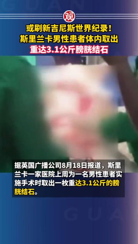 谁敢相信？斯里兰卡，一家医院的医护团队从一名55岁男子的膀胱中，取出了一颗重达3