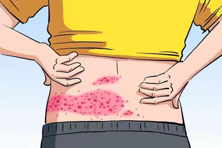 “蛇缠腰”真的会缠一圈夺命吗？揭开带状疱疹的3个真相，最后一个99%的人不知道！