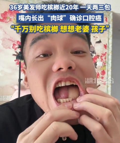 嘴馋一时，毁了一生！36岁美发师的血泪教训，给所有嚼槟榔的人敲碎警钟——这