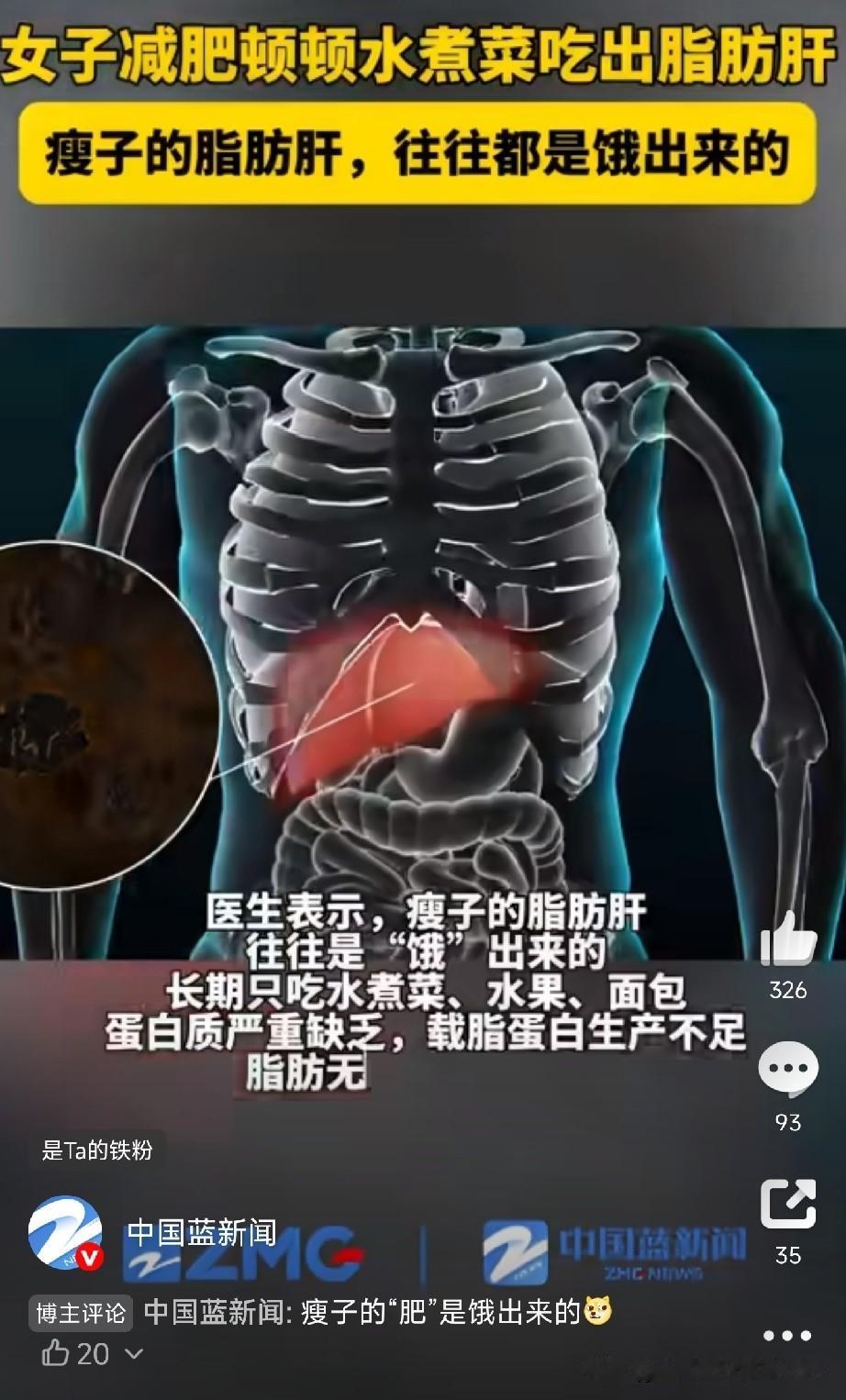 顿顿水煮菜，瘦了却查出脂肪肝！医生说这是“饿”出来的病杭州40岁的徐女士，为