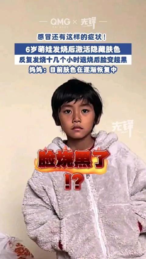最近看到个事儿，有个6岁男孩反复发烧十几个小时，退烧后脸居然变黑了，可把家长吓坏