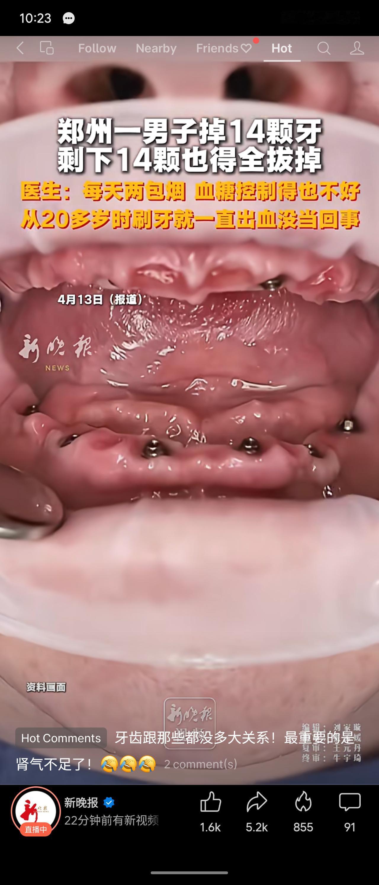 郑州一男子20多岁起刷牙出血未在意，每天两包烟且血糖控制不佳，最终掉14颗牙，剩