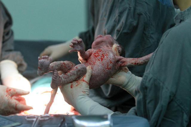 一位母亲在医院生三胞胎女婴, 宝宝剖腹产出生的一幕图片