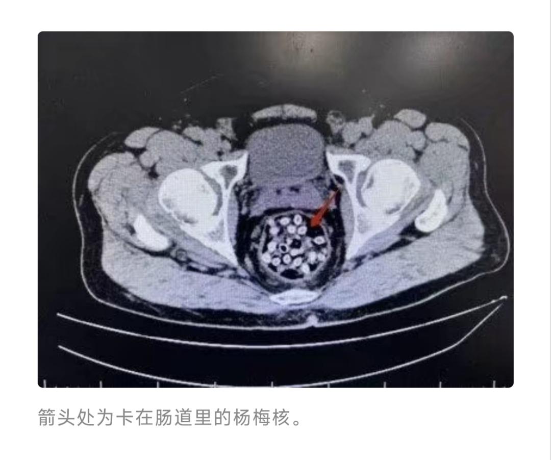 谁能想到，半筐杨梅下肚，差点把人送进鬼门关！肛门剧痛、冷汗直冒，肚子里的CT影
