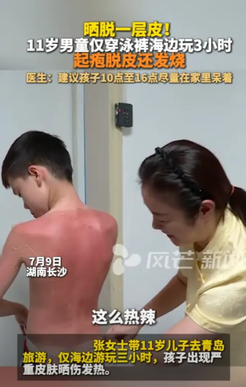 “太吓人了！”7月9日，湖南长沙，一名11岁男孩被太阳晒脱一层皮，浑身通红，还发