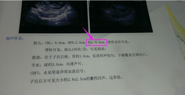 B超单子上FL/HL是什么? 股骨越长, 宝宝个子越高? 准妈妈进来看!