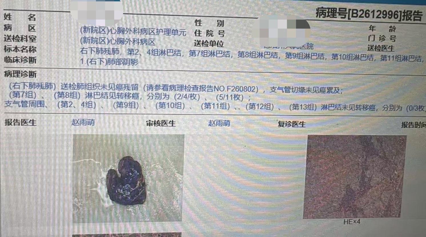 对于实性成分高的浸润性癌，系统性淋巴结清扫非常关键……后面的几个图都是...