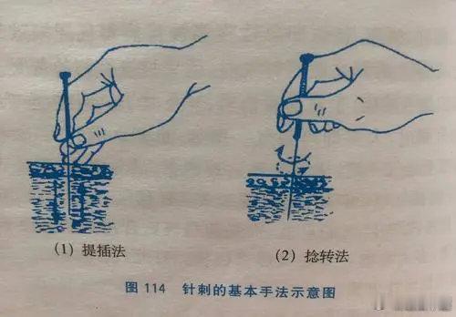 中医针灸：临床中，针灸“提插补泻法”，是如何操作的？提插二字，《灵枢·官能》：“