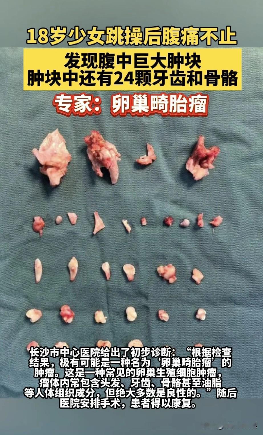 18岁女孩跳操后腹痛，腹中竟掏出24颗牙！医生：不是怪胎！18岁的姑娘小琳在家