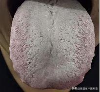 舌见白厚腻苔伴齿痕？湿食胶结困中焦，平胃散为破局良方伸出舌头照镜，若见一层