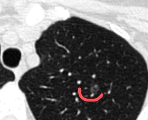 为了一个6mm的小结节，切掉一大块肺？如果是这样的手术，我坚决不做！今年38岁的