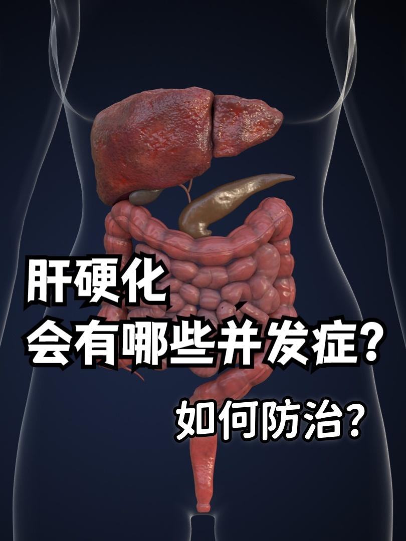 肝硬化有哪些并发症？如何防治？肝硬化的常见并发症包括：腹水、消化道出血、感染、
