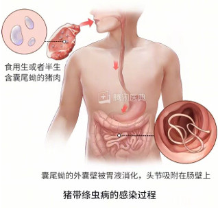 【#深圳女子如厕时排出3米长虫#！医生：像长寿面！】#砧板生熟混用致感染3米寄生