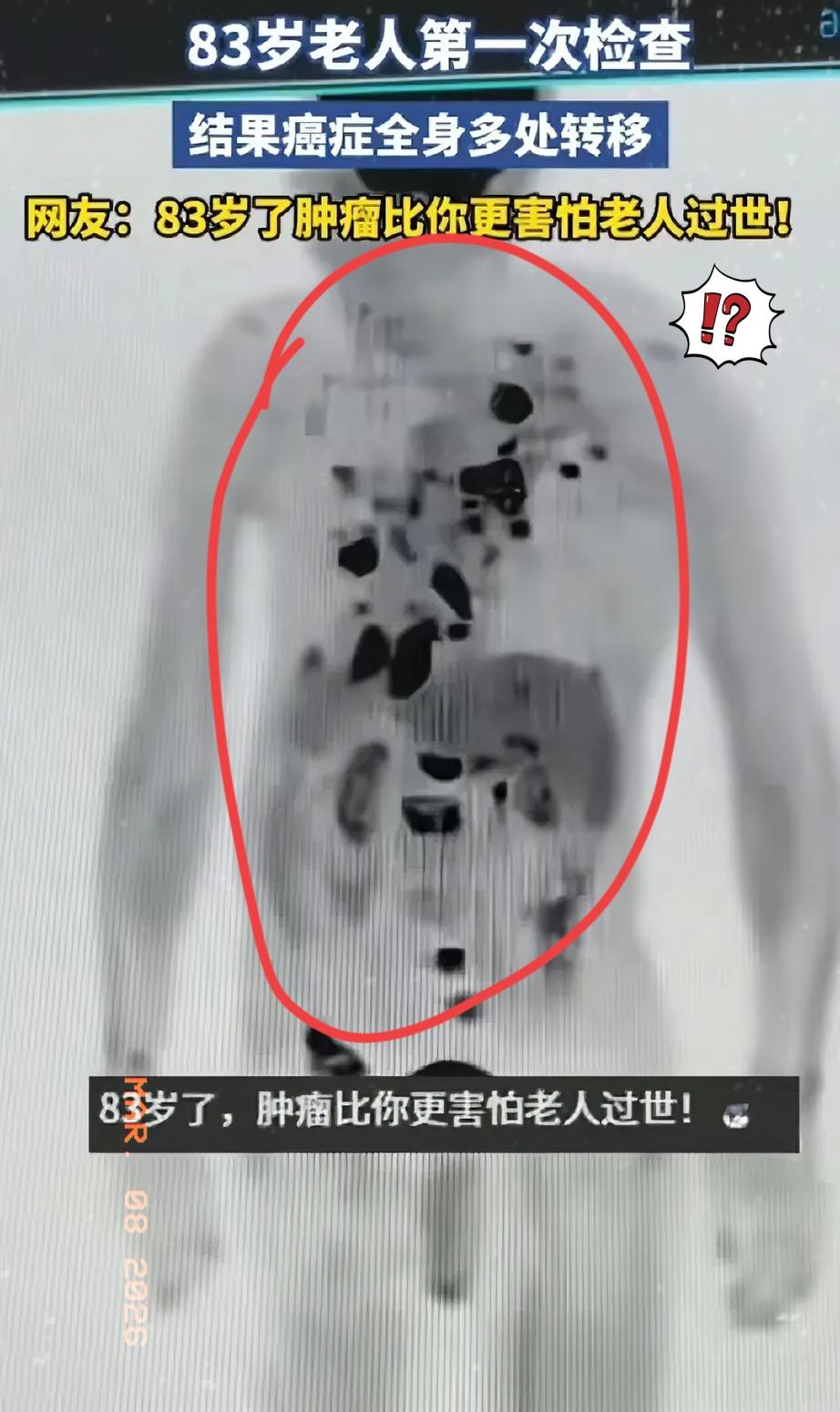 岁数大真有好处！安徽一位83岁的老人，第一次去做全身检查，结果片子一出来，医生