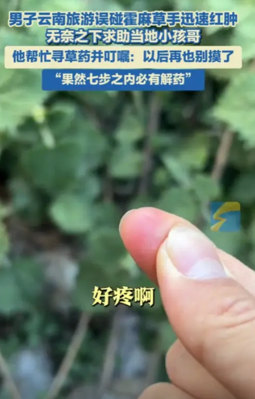 “这个小孩哥火了！”云南丽江，一男子去旅游误碰霍麻草，手迅速的红肿疼痛，无奈之下
