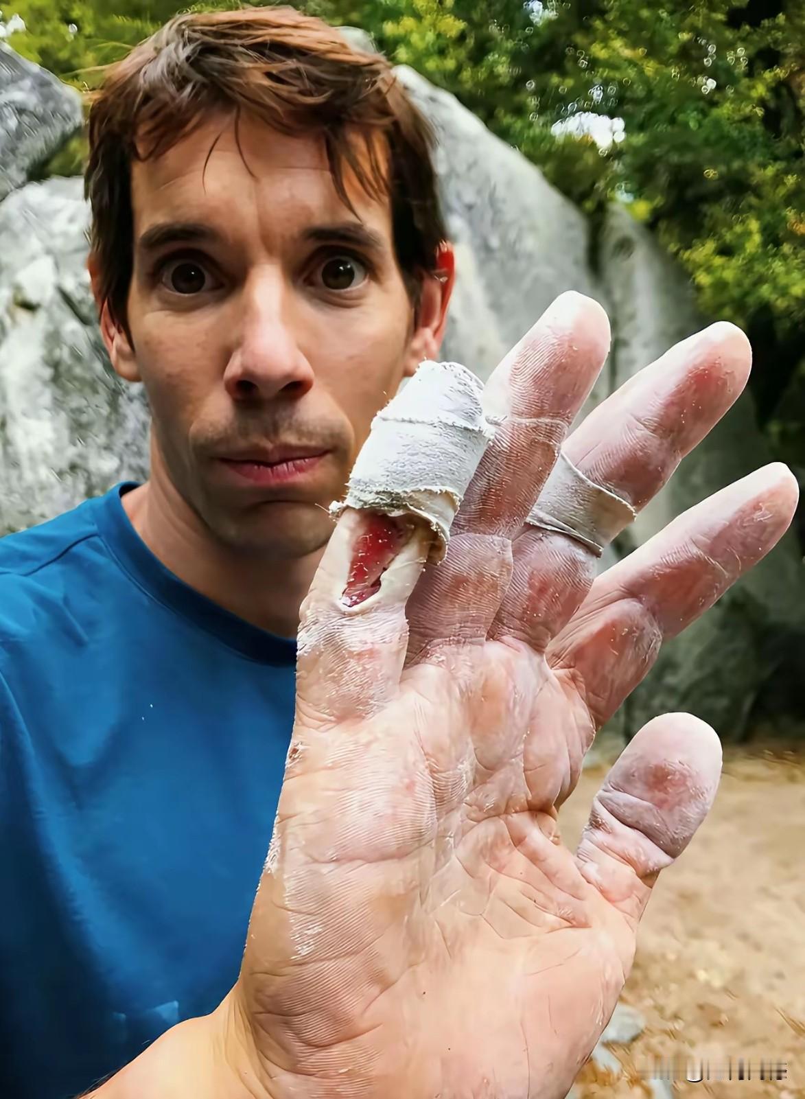 亚历克斯的手，原来也是有血有肉的，以往我们隔着屏幕看到的，都是他徒手攀爬的高光时