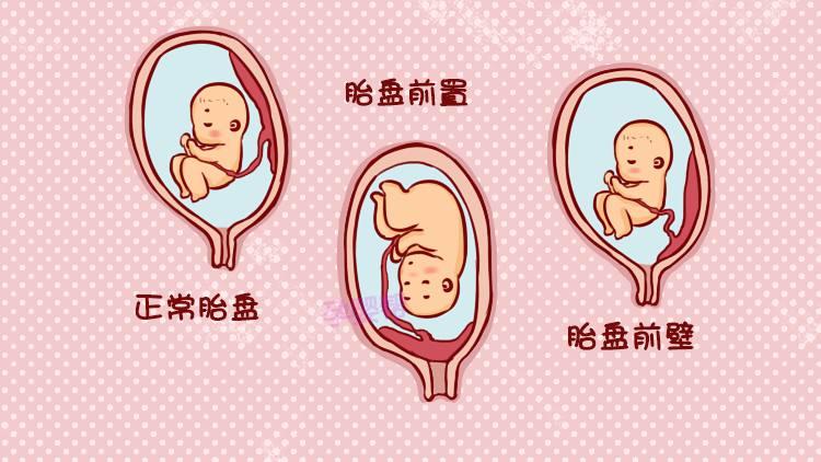 怀孕7次流产3次, 只因胎盘前置在“作梗”