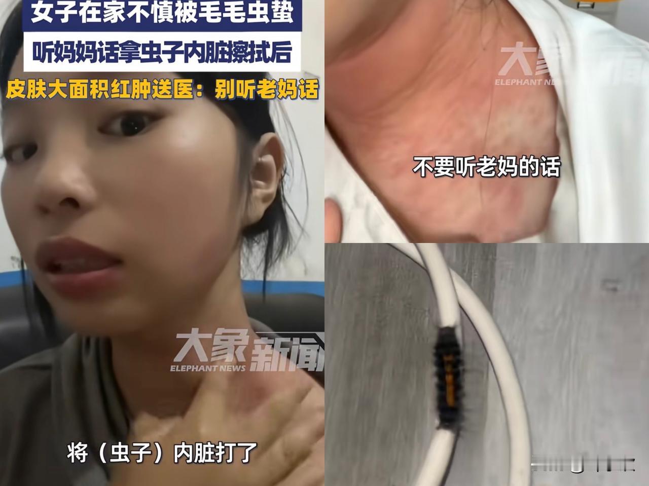 近日，贵州毕节，一女子在家被毛毛虫蛰了脖子，女子向老妈求助，老妈让她捣碎毛毛虫，