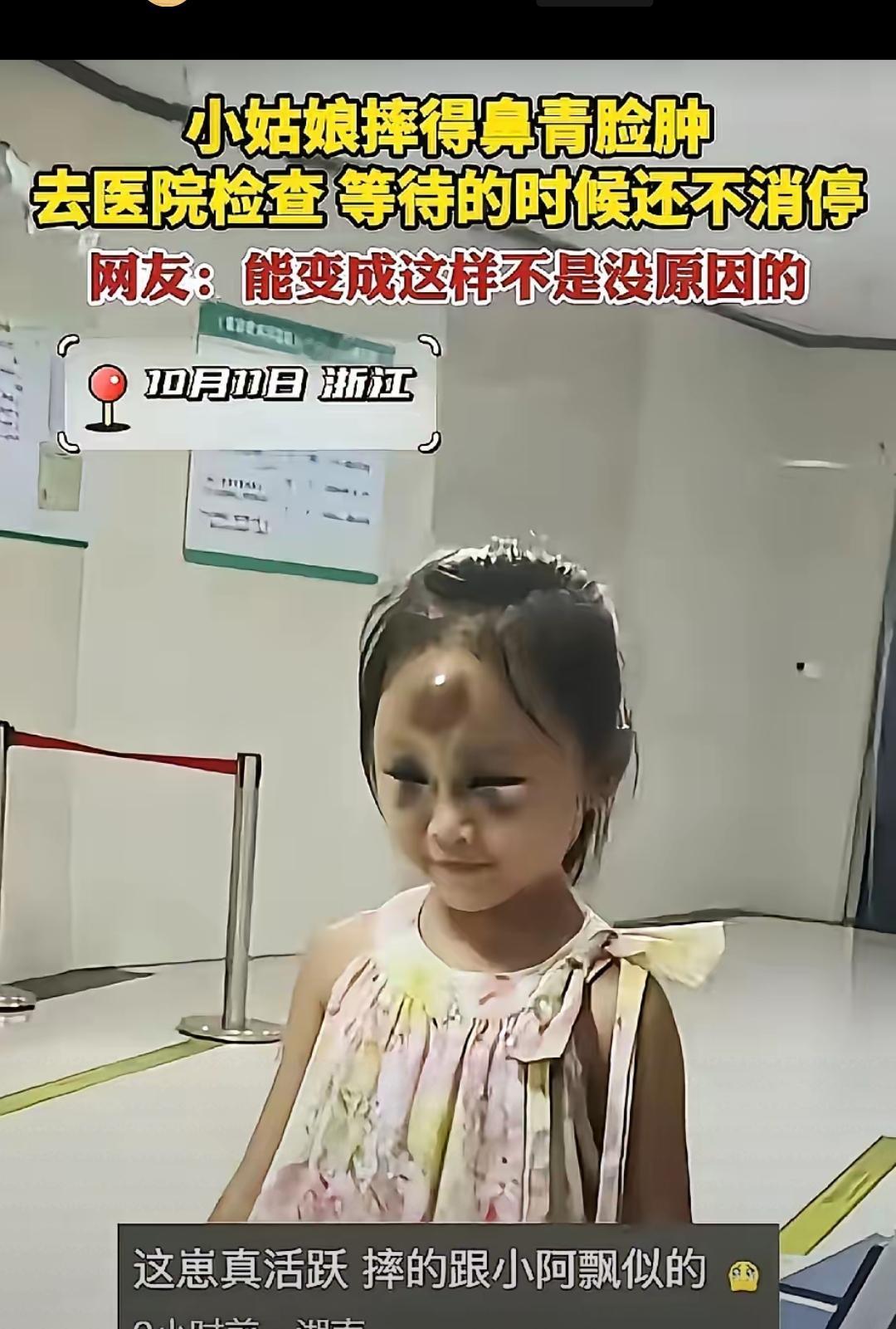 浙江小姑娘摔成“调色盘脸”还在医院蹦迪，这活力真能把人看乐！脸肿得青一块紫一块，