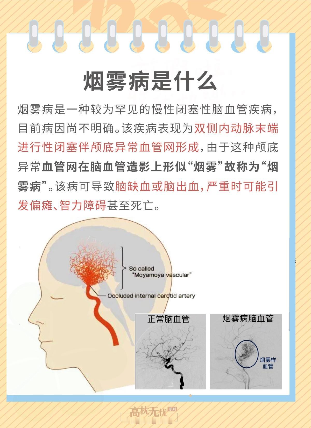 50岁阿姨做饭时突发头痛离世，这个“隐形杀手”太可怕，早知道能救命！