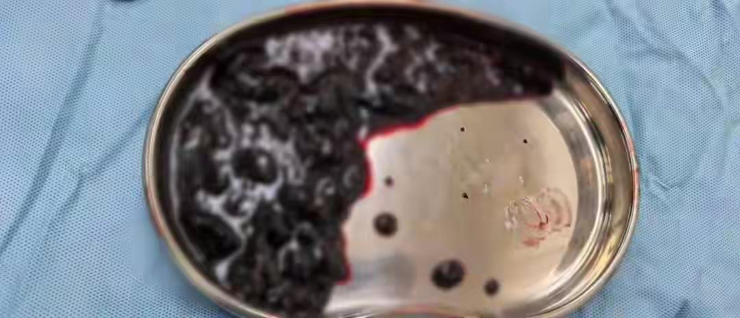 杭州90后女生滑雪惊魂记：一跤摔出“血馒头”，医生揭秘雪场自救真相，不会“摔”的