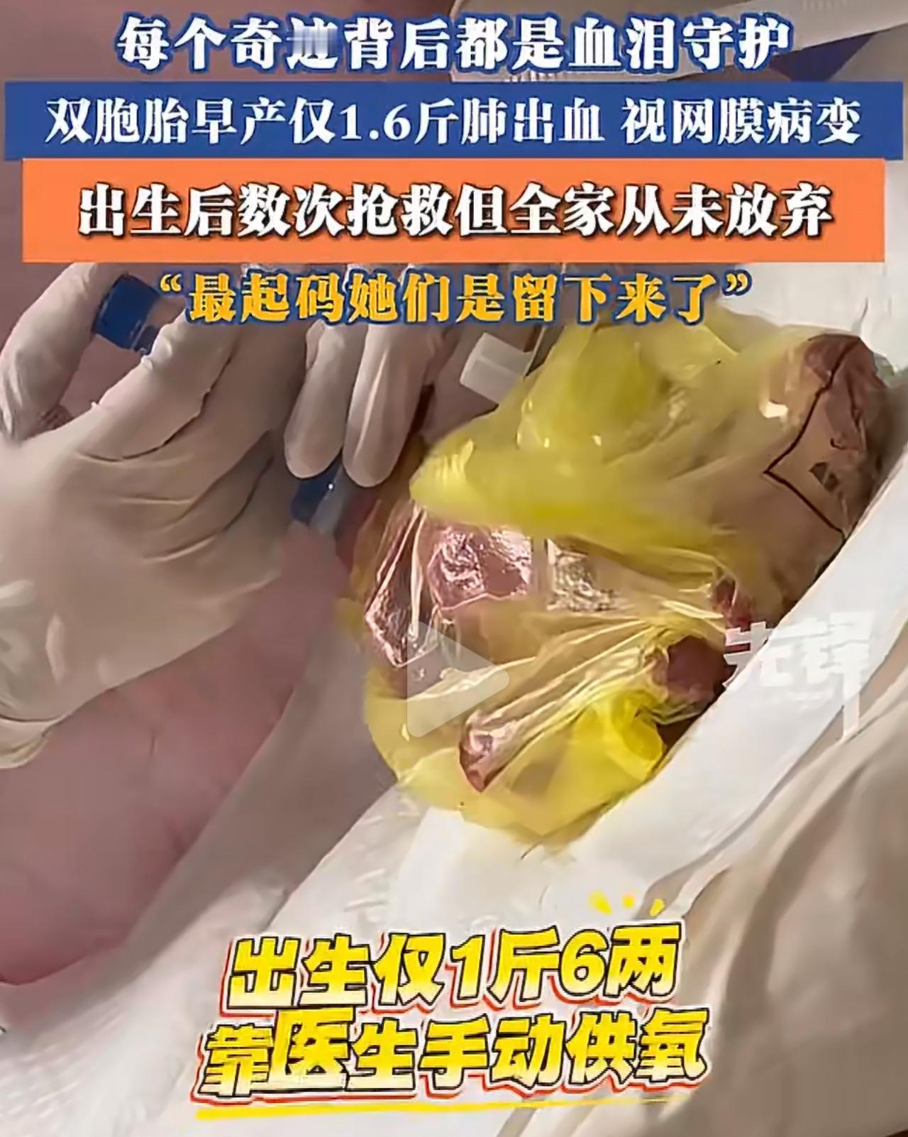贵州贵阳这对小姐妹，只在妈妈肚子里待了6个多月就急着出生，姐姐才750克，妹妹7