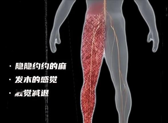 下肢疼痛串麻平时久坐之后，大家是否经常感到从臀部到大腿后侧、再到小腿外侧有酸痛